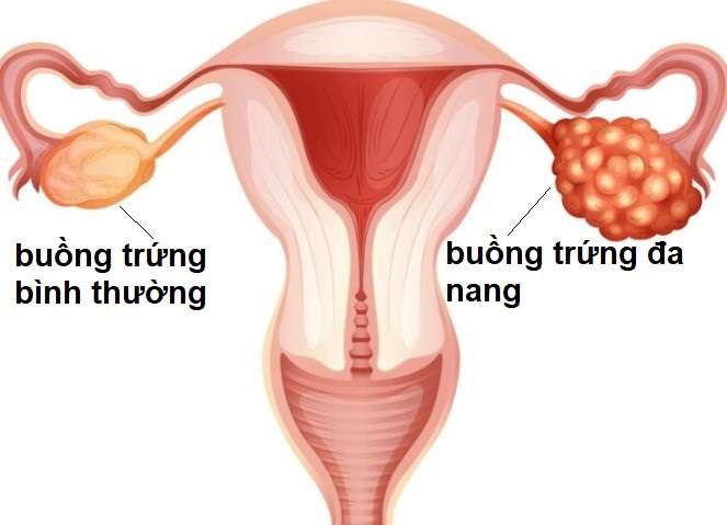 buồng chứng đa nang là gì