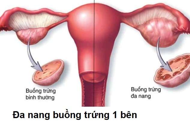 Bị đa nang 1 bên buồng trứng