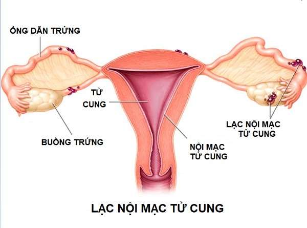 lạc nội mạc tử cung là gì