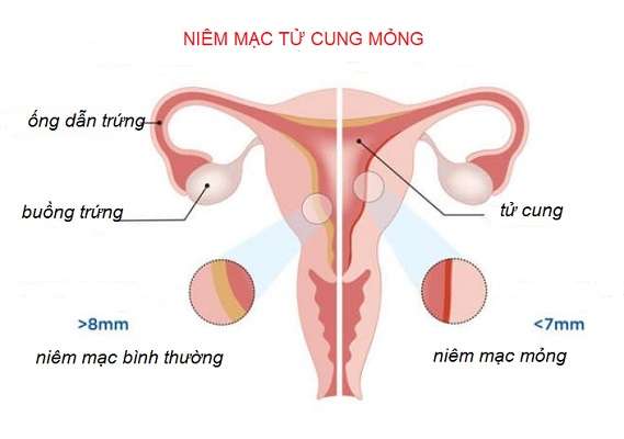 niêm mạc tử cung mỏng