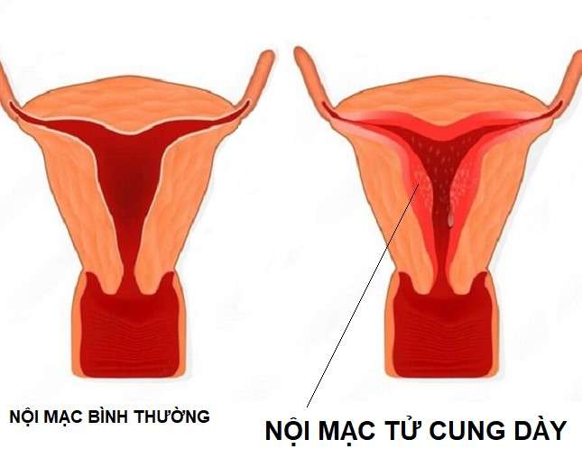 niêm mạc tử cung dày