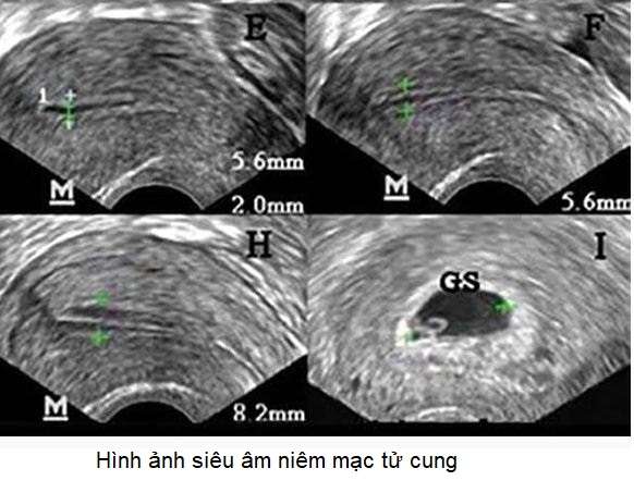 hình ảnh siêu âm niêm mạc tử cung