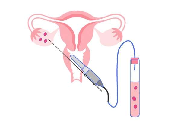 Top 10 câu hỏi thường gặp về mini IVF - Stafam